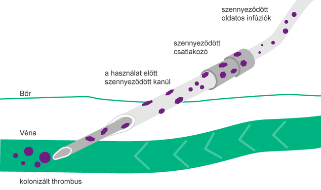 Illustration of Extra- and intraluminal route of contamination using a contaminated catheter.